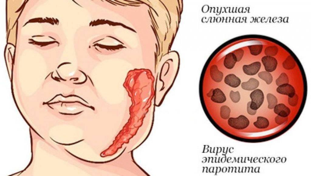 Вирус эпидемического паротита клиническая картина